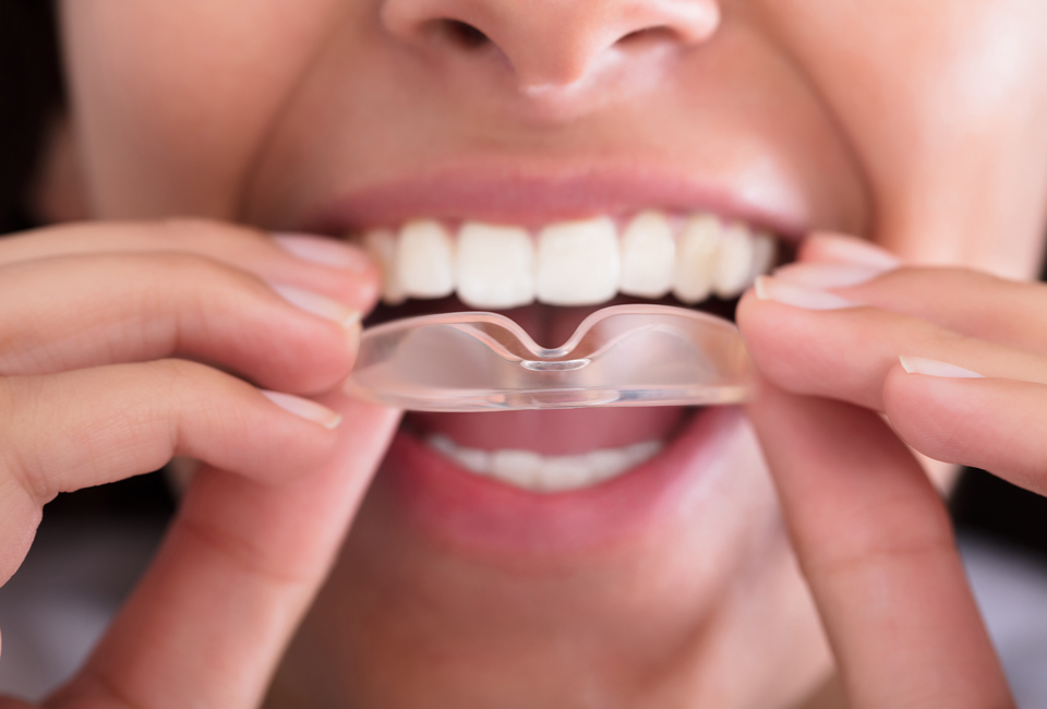 Set of four anti grinding dental guards